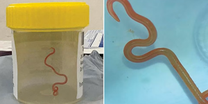 Première mondiale : un médecin découvre un ver parasite vivant, dans le cerveau de sa patiente