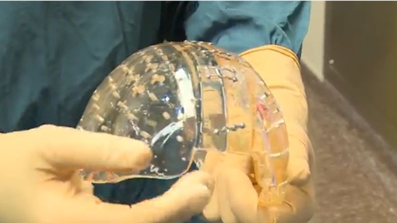 Une prothèse de crâne imprimée en 3D posée avec succès