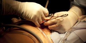 L'opération de l'appendicite est-elle banale ?