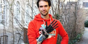 Une prothèse de main robotisée en impression 3D