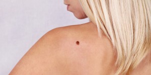 Cancer de la peau : surveillez vos bras