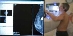 Cancer du sein: 93 mutations génétiques impliquées