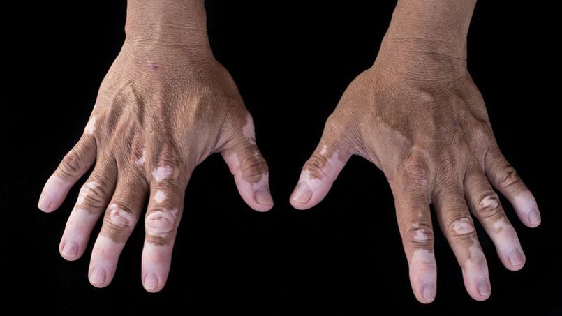Le vitiligo, cette maladie qui éclarcit la peau