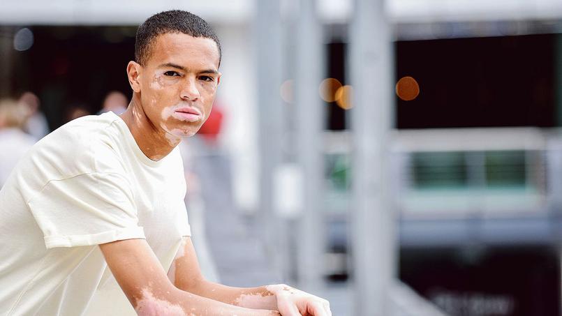 De nouvelles solutions en vue contre le vitiligo
