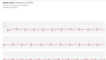 «Le Figaro» a testé l’électrocardiogramme de l’Apple Watch