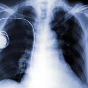 Implants médicaux: un rapport parlementaire pointe les défaillances du système