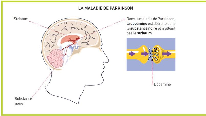 Journée Mondiale contre la maladie de Parkinson: où en est la recherche?