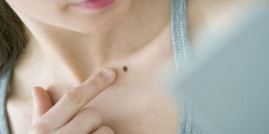 Cancer de la peau: bien surveiller ses grains de beauté