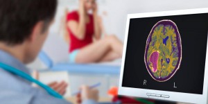 Cancer du cerveau: un nouveau traitement prometteur contre le glioblastome