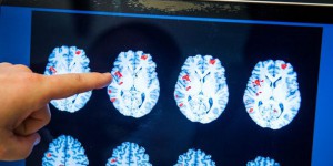 Manipulation cérébrale: faudra-t-il interdire les concours aux épileptiques?