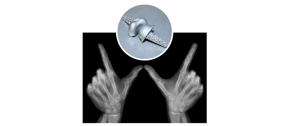 <SPAN class='cnt-hdr-cmp__sctn'>radioanatomie</SPAN> - Sciences : des implants articulaires proches de la perfection