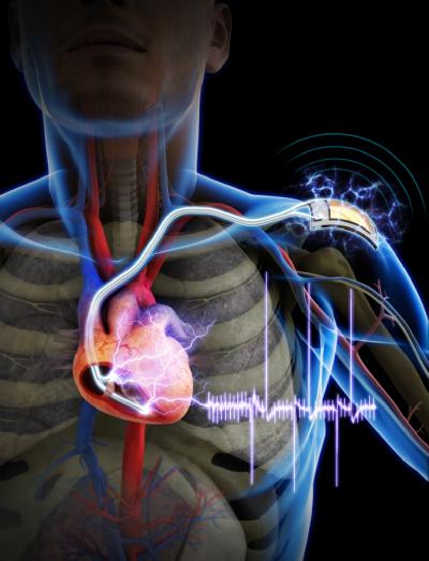 Un nouveau pacemaker pour éviter de repasser sur le billard