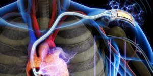 Un nouveau pacemaker pour éviter de repasser sur le billard