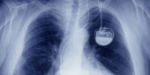 Le plus petit pacemaker sans fil au monde implanté chez nous 