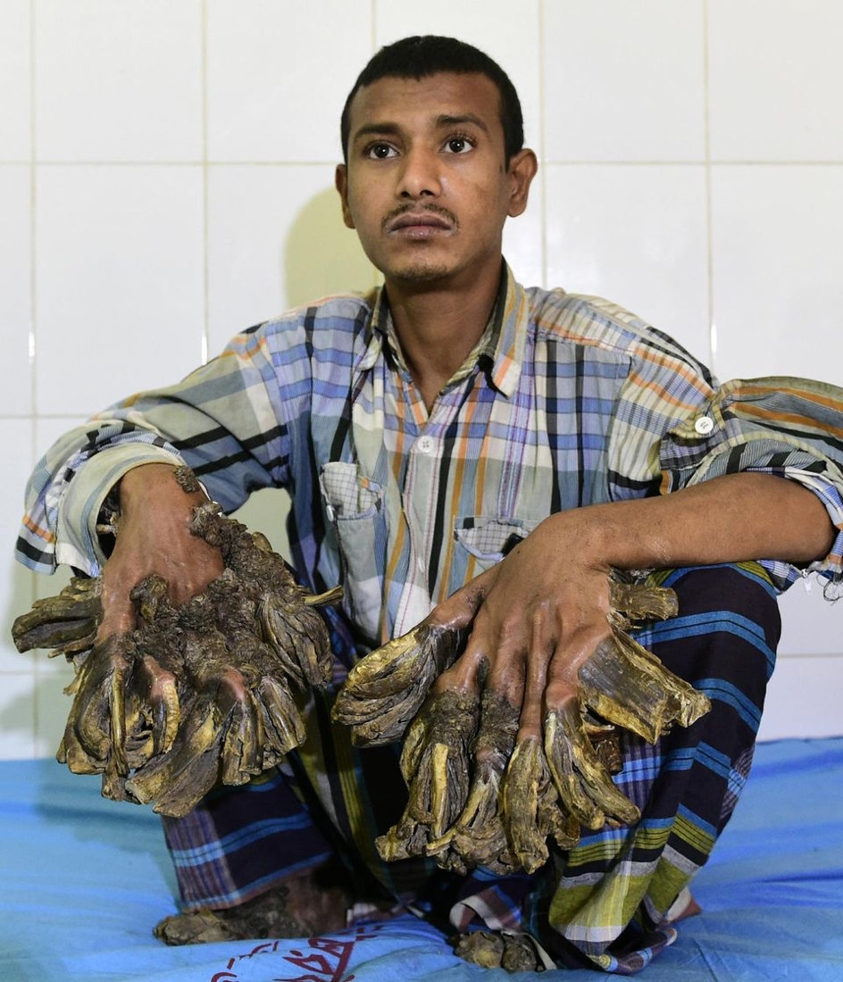 «L’homme arbre» du Bangladesh va enfin être opéré 