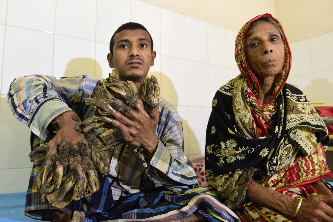 9 médecins et 3h30 pour réussir l’opération de l’«homme-arbre» du Bangladesh 
