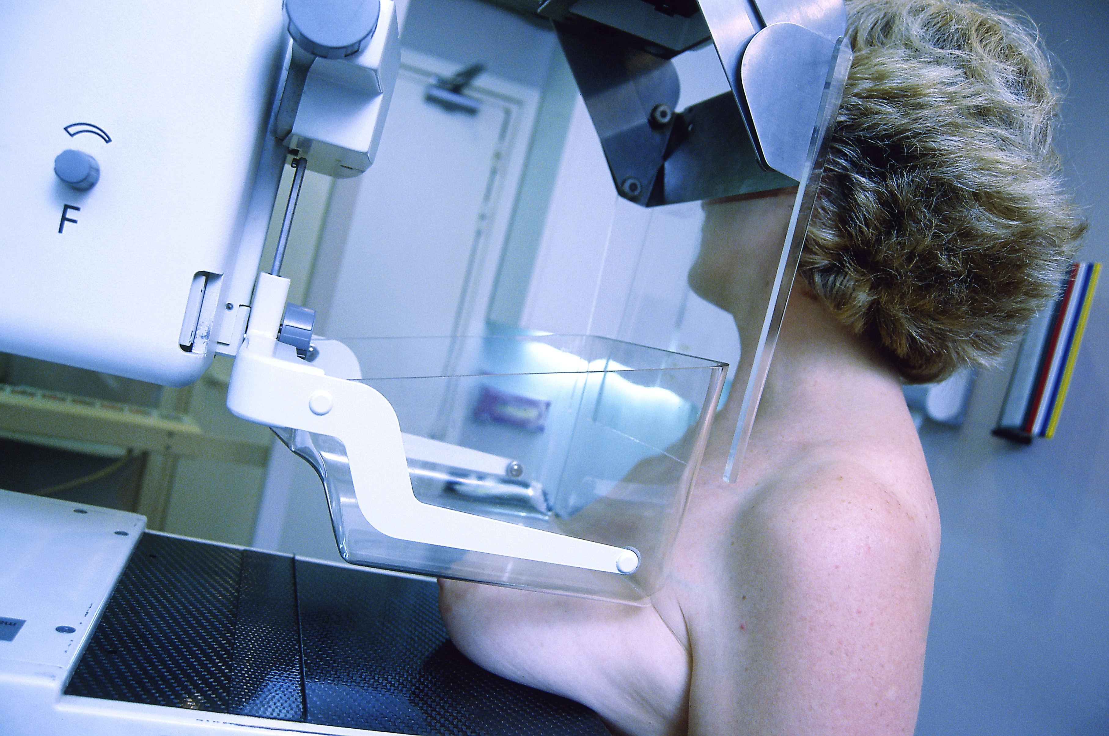 Cancer du sein: des découvertes génétiques qui pourraient aboutir à de nouveaux traitements 