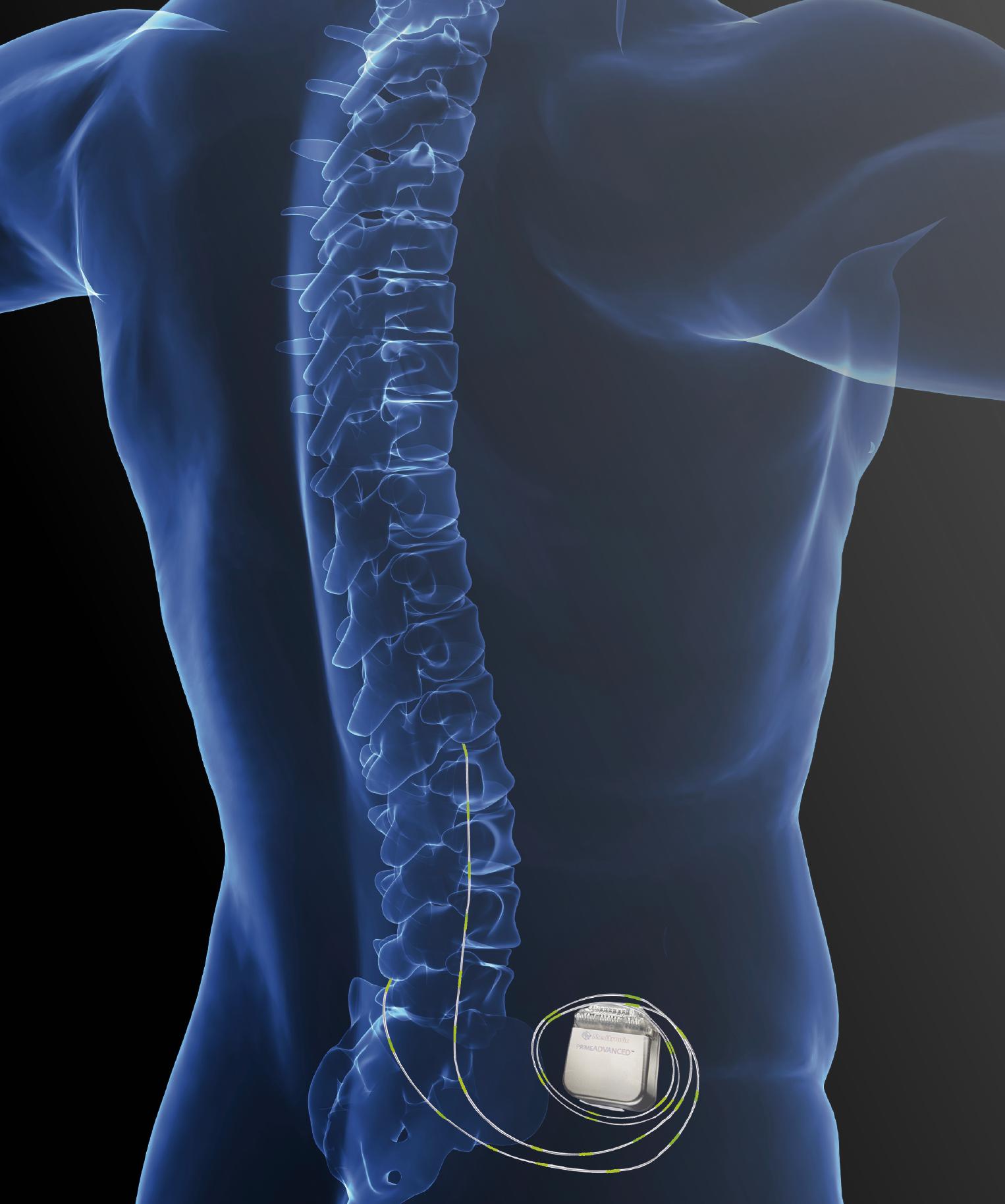Mal de dos : un implant pour court-circuiter la douleur 