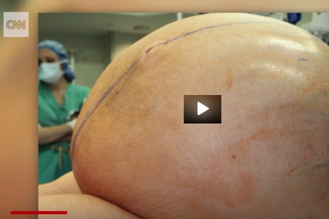 Une tumeur de 60 kilos extraite du corps d’une femme 