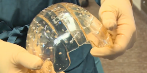 Première implantation d'un crâne en plastique imprimé en 3D