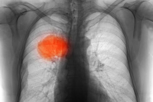Cancer du poumon: opération non invasive