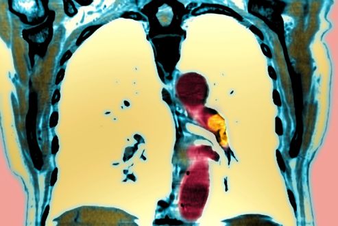 Embolies pulmonaires : un poids sous-estimé