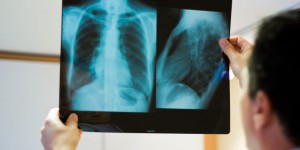 L'ONU veut intensifier la lutte contre la tuberculose