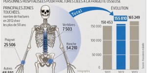 Ostéoporose, 165.000 hospitalisations par an
