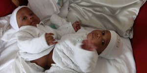 Exploit chirurgical à Necker : des bébés siamois séparés