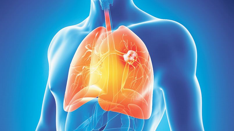 Cancer du poumon : pas de dépistage organisé