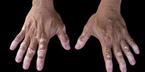 Le vitiligo, cette maladie qui éclarcit la peau