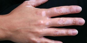 Vitiligo : «Le poids des regards est parfois pesant »