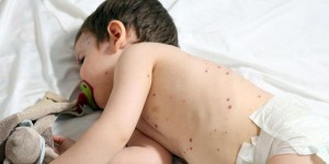 Attention, les cas de varicelle se multiplient