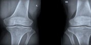 L’arthrose du genou est deux fois plus fréquente qu’il y a 100 ans