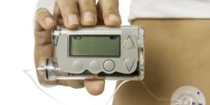 Diabète de type 1 : la pompe à insuline plus sûre que l’injection manuelle