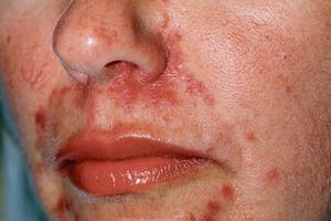 Couperose, rosacée: d’où viennent ces rougeurs au visage?