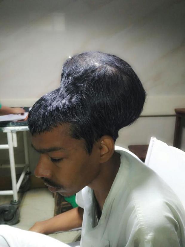 Un homme atteint d’une tumeur au cerveau de 1,8 kg a été opéré en Inde 