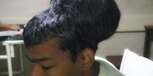 Un homme atteint d’une tumeur au cerveau de 1,8 kg a été opéré en Inde 