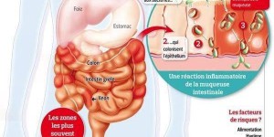 Maladie de Crohn, rectocolite hémorragique: quand les intestins s’emballent