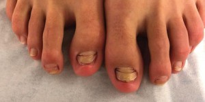 Après une «fish pédicure», une femme a perdu des ongles de pied