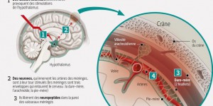 À quoi sont dues les migraines ?