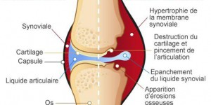 Des articulations raides et douloureuses, symptômes d’une polyarthrite rhumatoïde