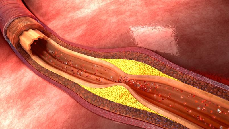 Athérosclérose: comment savoir si nos artères sont en mauvaise santé?
