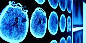 L’intelligence artificielle pourrait améliorer la prise en charge des tumeurs au cerveau