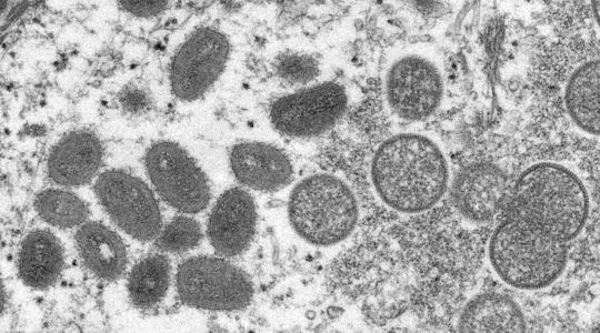 Pourquoi l'OMS veut renommer la variole du singe