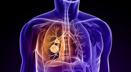 Cancer du poumon : Pour la première fois de l'Histoire, sa disparition est à notre portée