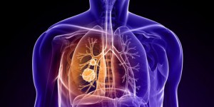 Cancer du poumon : Pour la première fois de l'Histoire, sa disparition est à notre portée