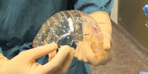 Première mondiale : un crâne imprimé en 3D implanté avec succès à Utrecht