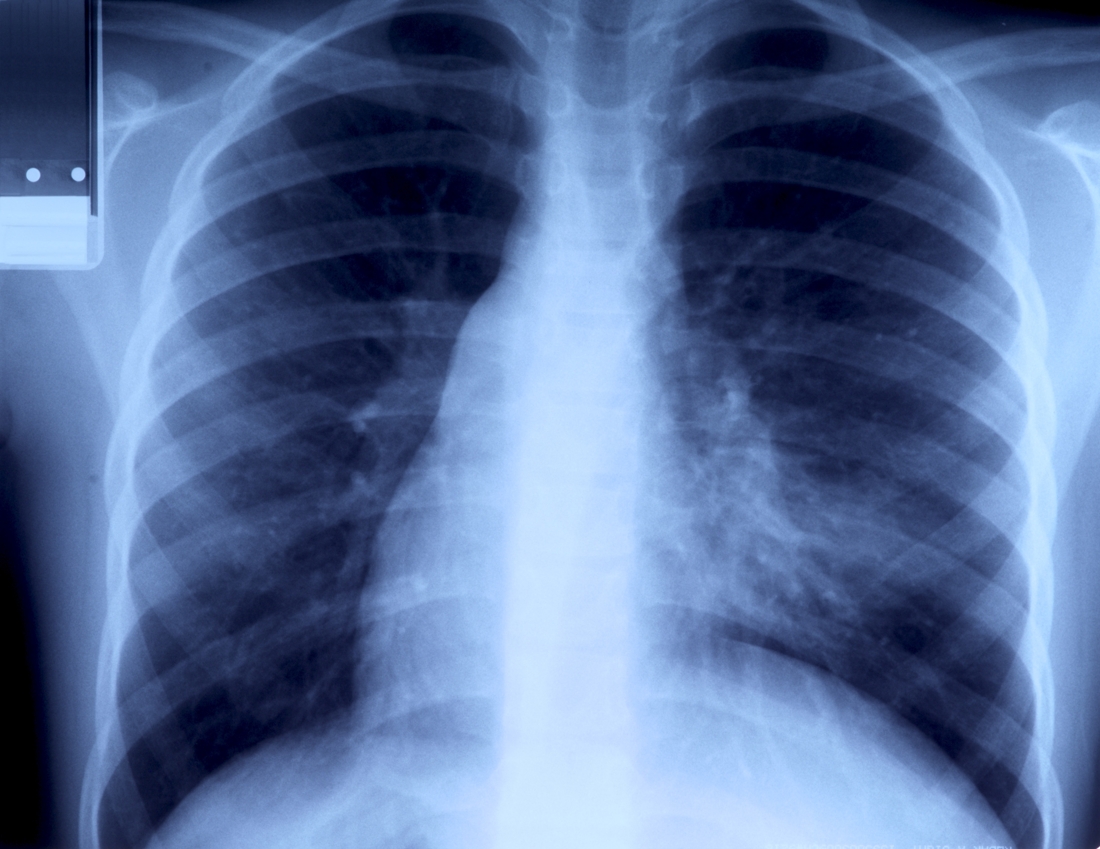 Être hospitalisé pour une pneumonie accroît le risque cardiovasculaire