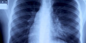 Être hospitalisé pour une pneumonie accroît le risque cardiovasculaire